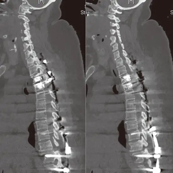 NCCT Dorsal Lumbar Spine